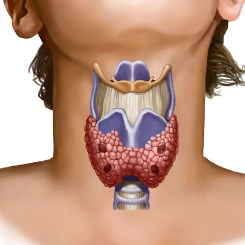 Программа «Лечение щитовидной железы»