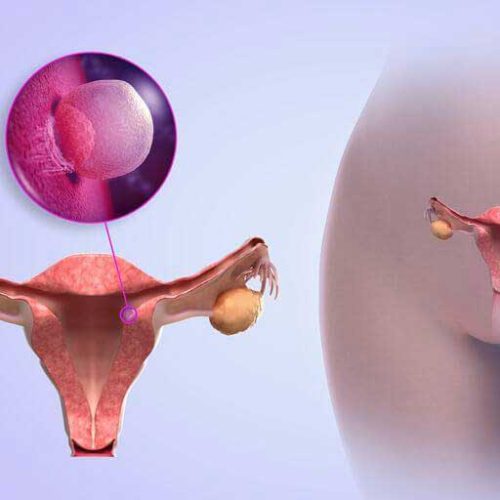 Программа «Лечение рака матки»